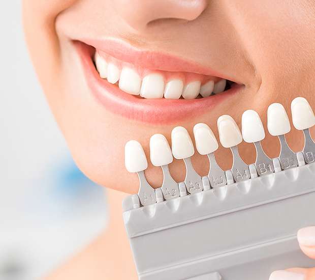 Ballston Spa Dental Veneers and Dental Laminates